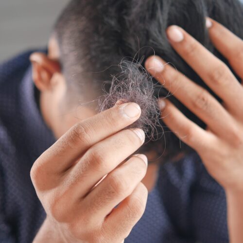 Vypadané kolečko vlasů: jaký je důvod lysého místa na vaší hlavě?