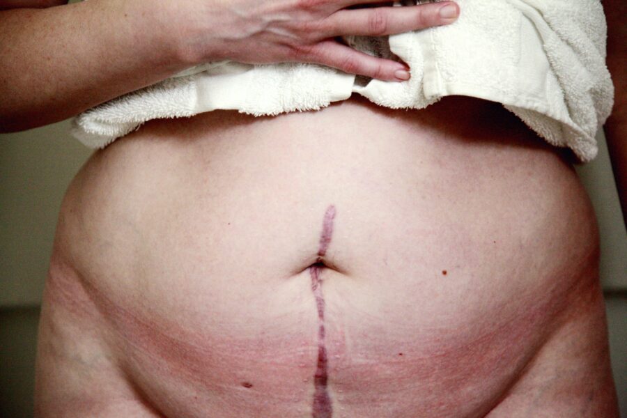 Vytahané břicho po porodu: 4 tipy, jak se vyhnout abdominoplastice